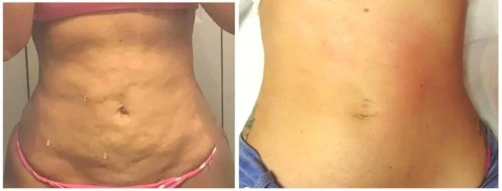 Liposuction imperfections