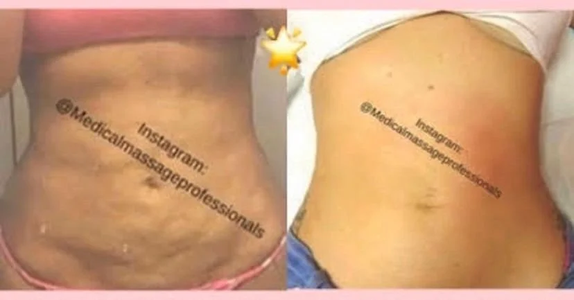 Miami P fibrosis.jpg