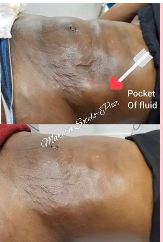 fibrosis with seroma.jpg