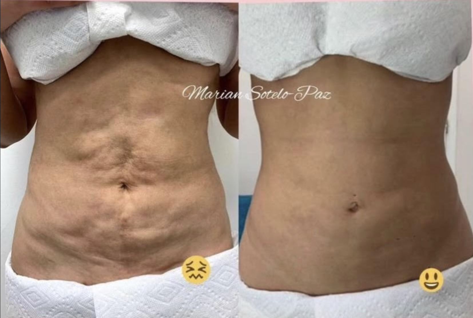 after lipo fibrosis.png