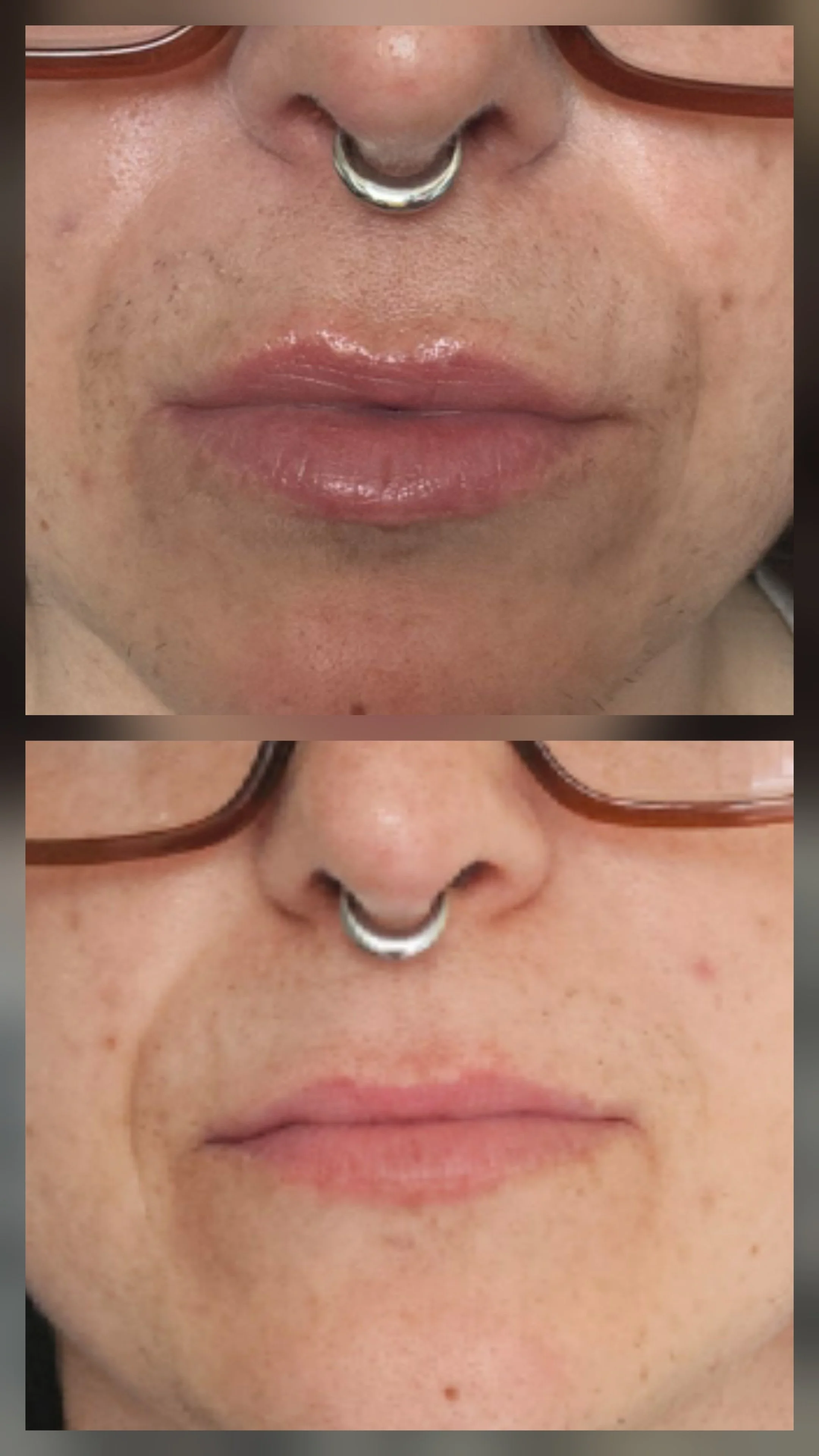 Close-up of a person's nose, lips, and chin with two photos showing before and after skin treatments, piercings, and glasses.