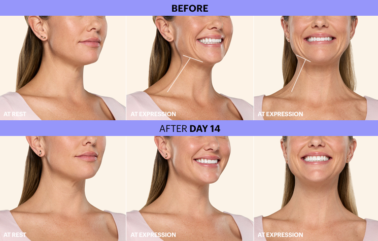 Comparison of a woman's face before and after 14 days of a treatment. The top row shows her relaxed, at rest, with a slight double chin and less defined jawline. The middle images show her smiling with more relaxed jaw muscles, indicating expression. The bottom row shows her smiling after 14 days, with a more lifted jawline, less double chin, and improved facial contours.