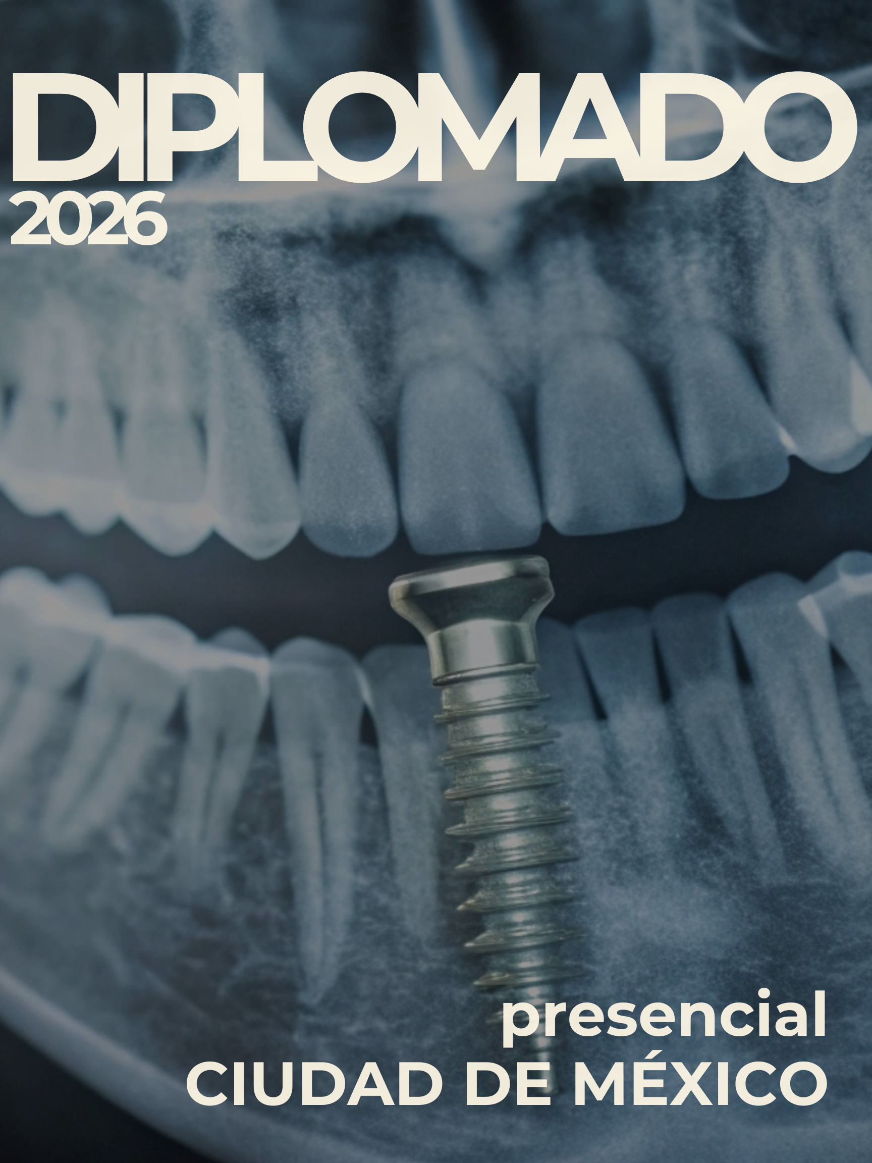 Boca con dientes mostrando una implante dental en la parte inferior, con el texto 'Diplomado 2026 presencial Ciudad de México'.
