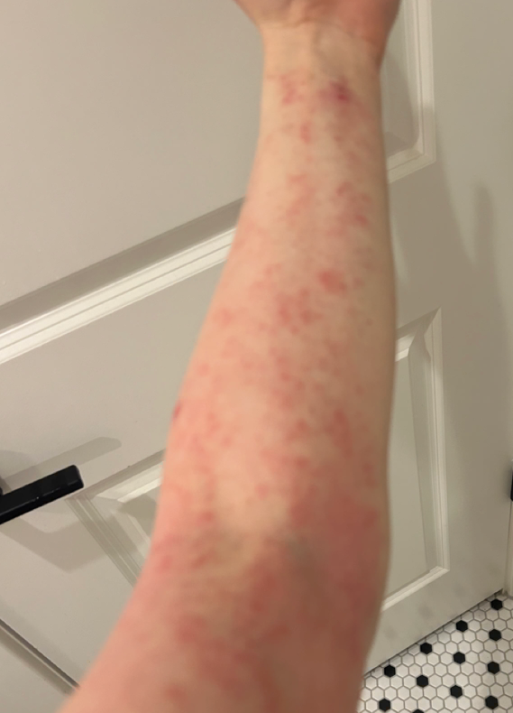 A forearm with red, inflamed, and irritated skin, possibly indicating an allergic reaction or skin condition.