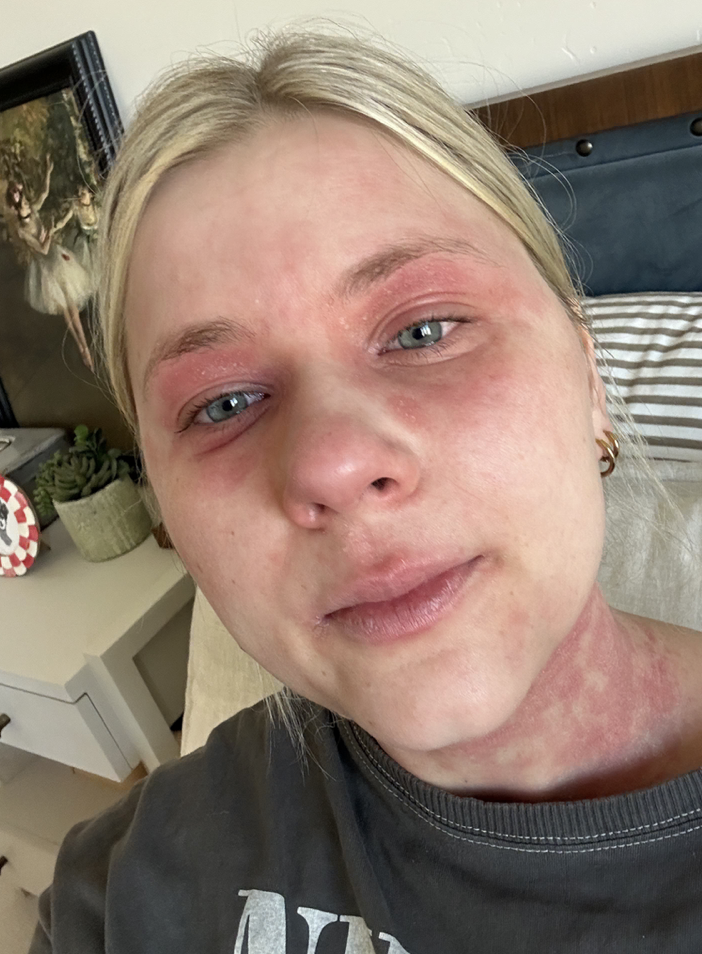 Close-up of a young woman with blonde hair and blue eyes, displaying redness and irritation on her face, neck, and around her eyes, lying in bed with a neutral expression.