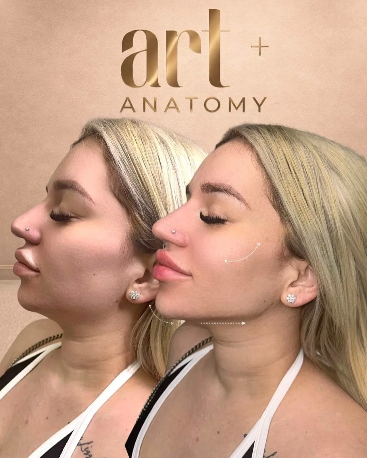 Full Face is not about changing who you are &mdash; it&rsquo;s about enhancing your natural features and restoring balance to the face.

In this treatment, we work with:
&bull; Jawline definition
&bull; Chin projection
&bull; Cheek contouring
&bull; 