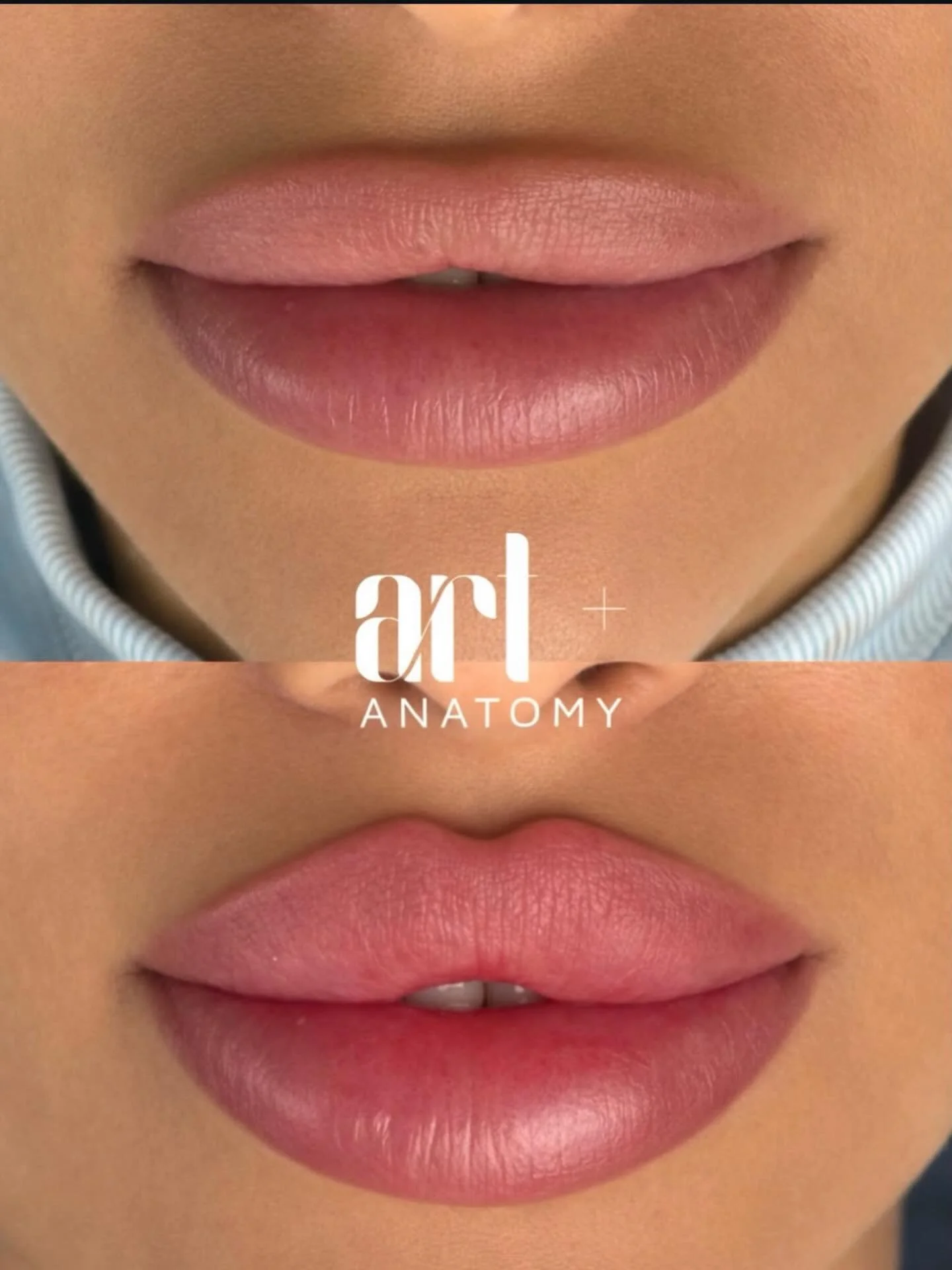 Russian Lips &mdash; where shape matters 🤍

Not just volume.
Not overfilled lips.
But precise architecture, a clean contour, and elegant height &mdash; this is what Russian Lips are about.

✔ defined Cupid&rsquo;s bow
✔ vertical technique without he