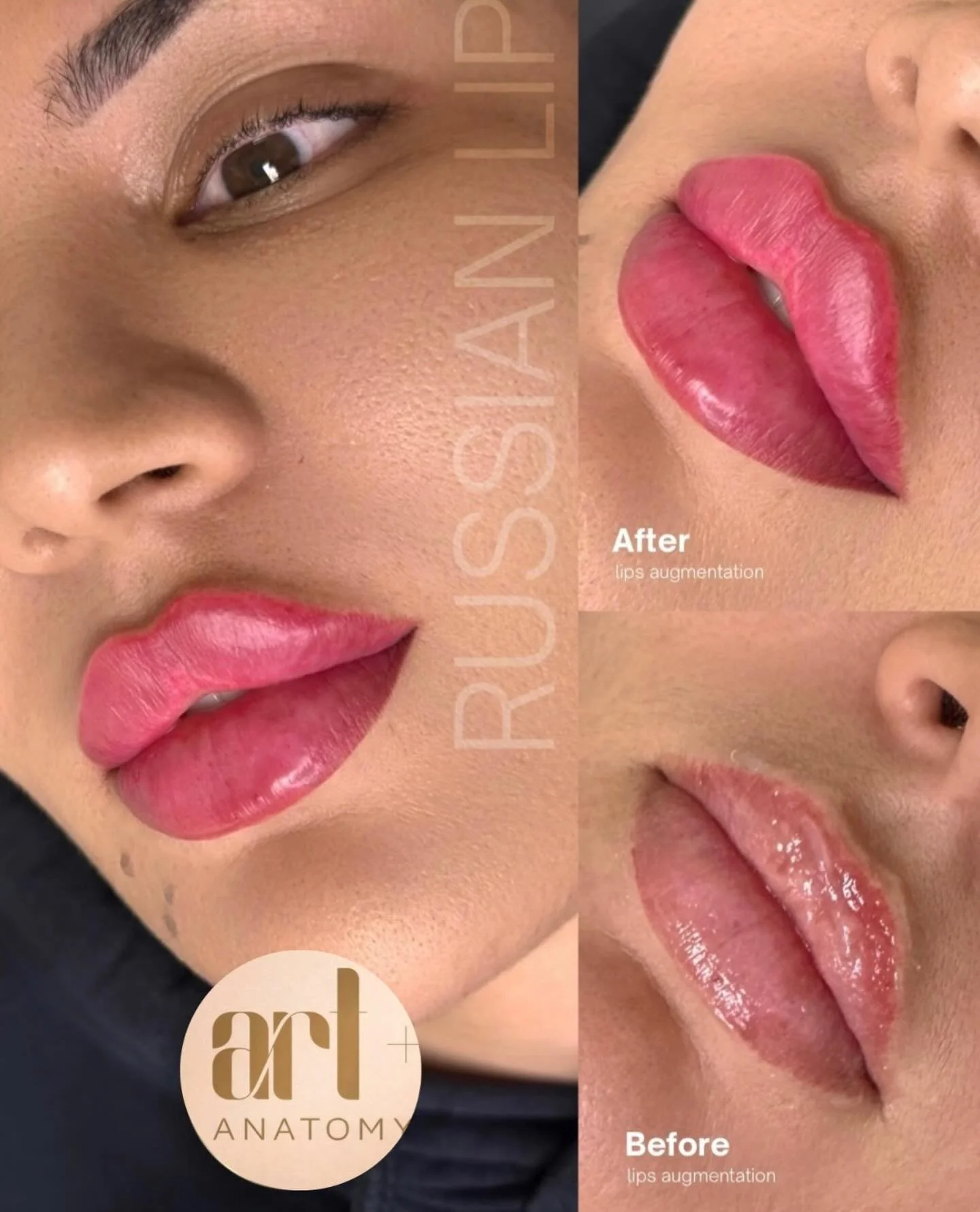 Obsessed with these results 😍💉

Lip specialists with over 12 YEARS EXPERIENCE! 

This result was achieved using 1ML 🪄 

DM TO BOOK 📩

#russianlipsnyc #lipfillernyc #russianlipslasvegas #lasvegaslipfiller