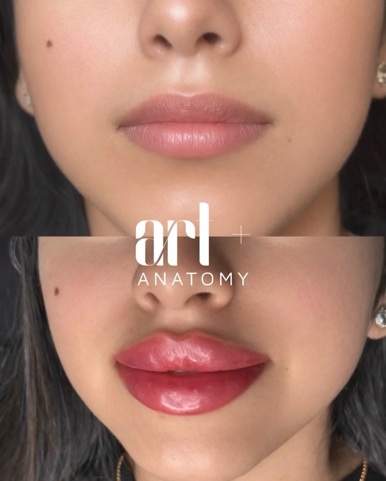 Lips Augmentation | New York

Soft volume. Defined contour. Natural balance.
Our lip augmentation enhances your natural beauty without overfilling or changing your features.

✨ Smooth, hydrated lips
✨ Clear post-procedure contour
✨ Natural shape &amp