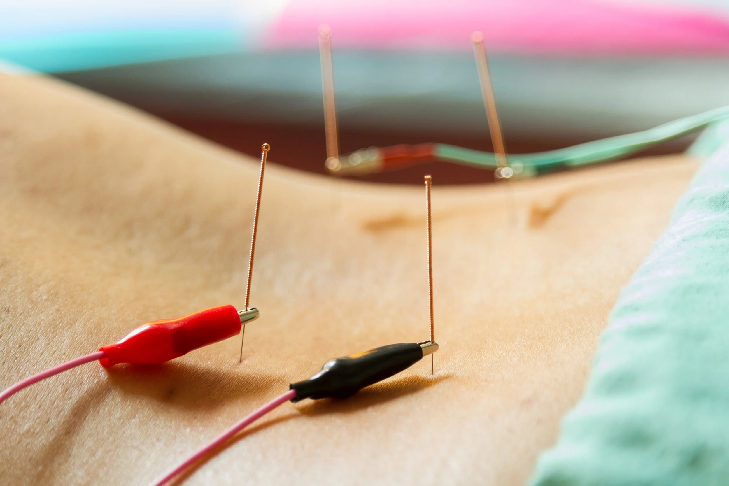  Electroacupuncture  — A modern adaptation of acupuncture where small clips connect needles to a device that delivers gentle electrical pulses, increasing stimulation at targeted points to enhance therapeutic effects for conditions like pain, neuropa