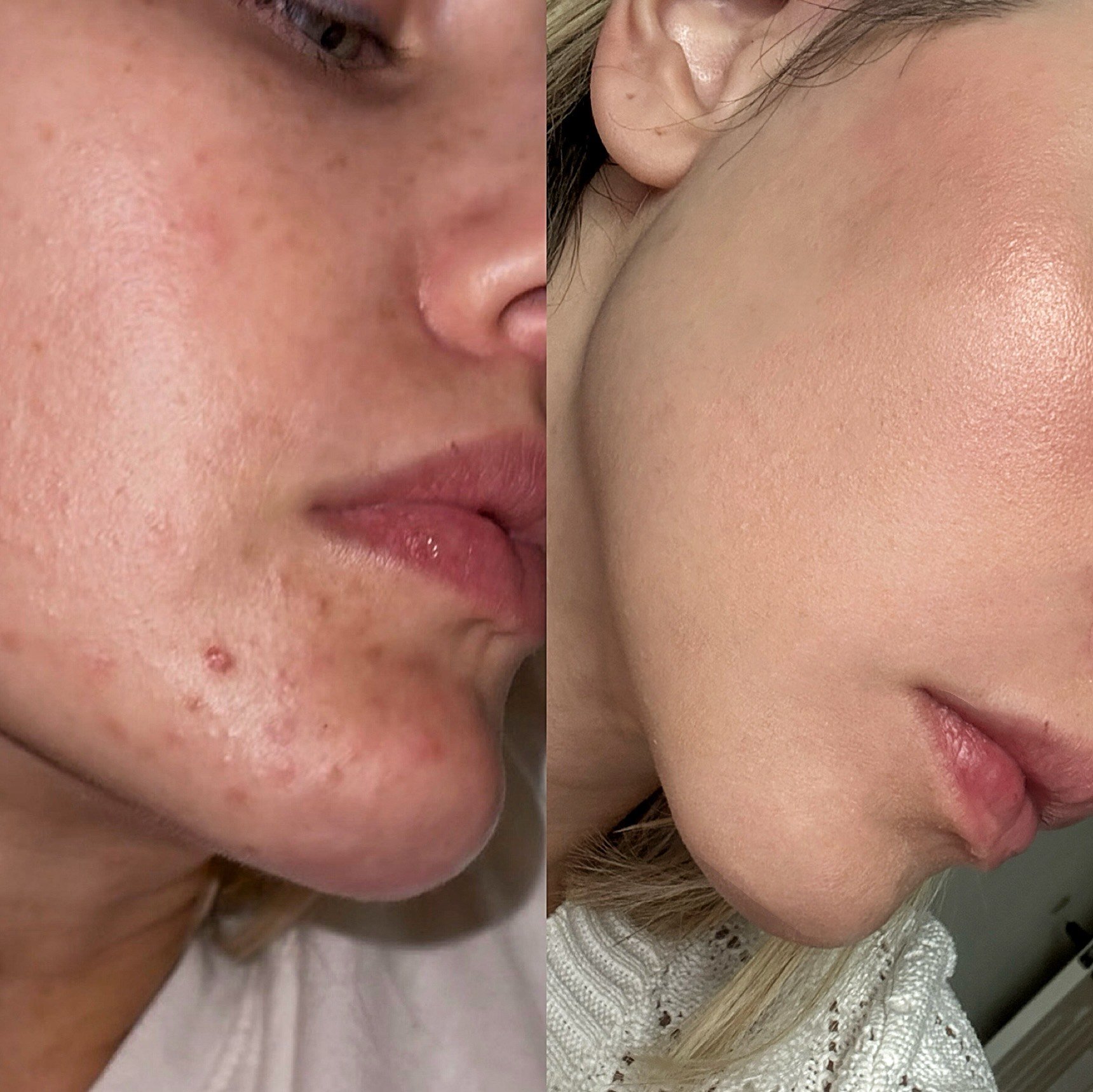 Side-by-side comparison of a woman's face showing skin before and after skincare treatment, with visible camera focus on cheeks and jawline.