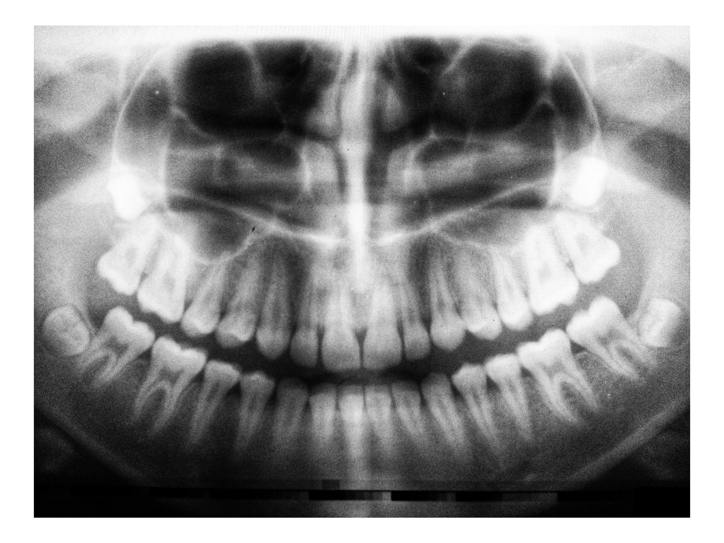 Impacted wisdom teeth x‑ray image for oral surgery planning in Texarkana