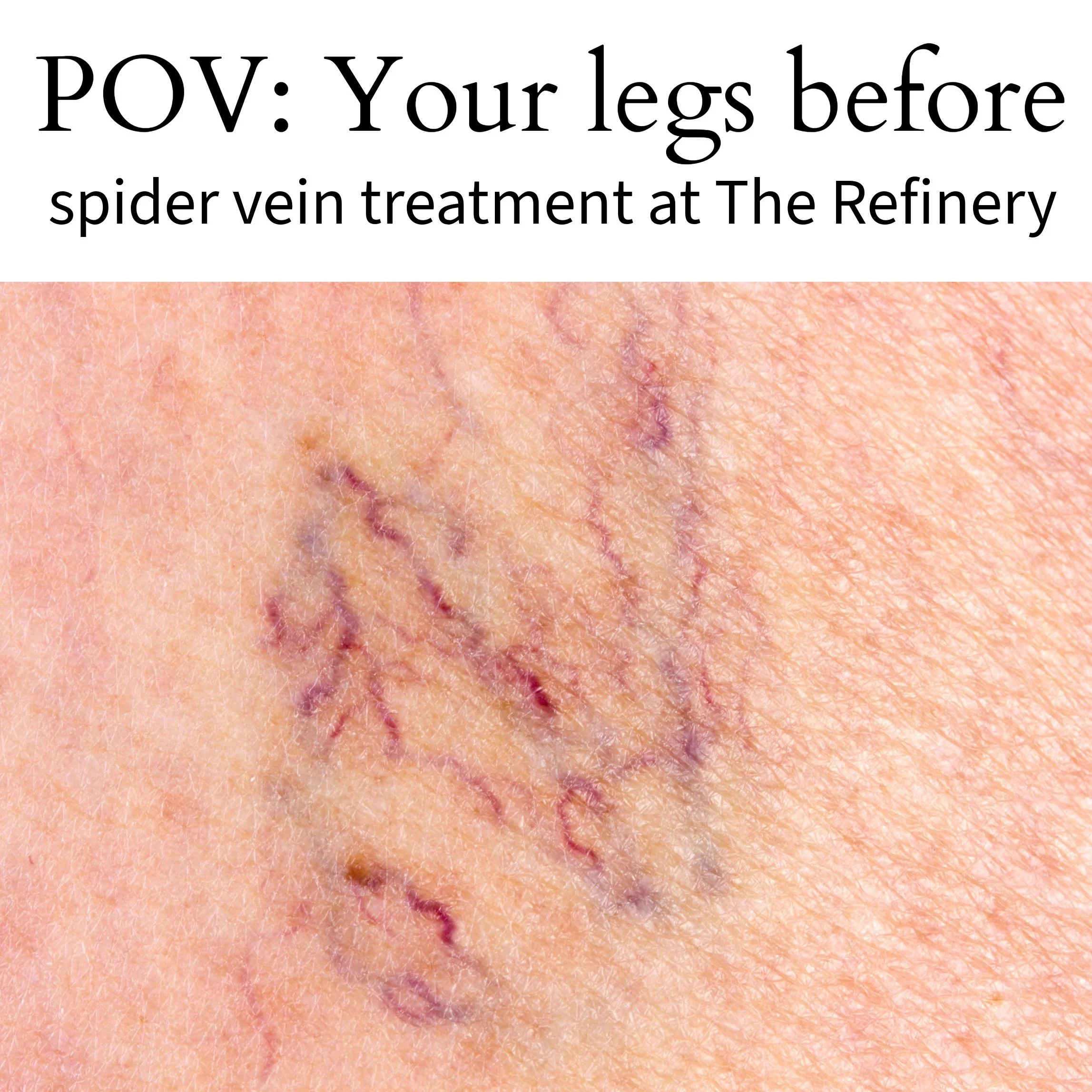 How do I get rid of spider veins?