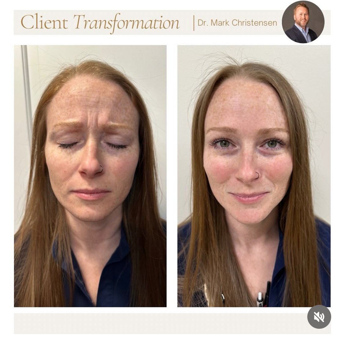 Botox patient. Before and after photos show a woman with long red hair, demonstrating client transformation, with improved skin appearance.