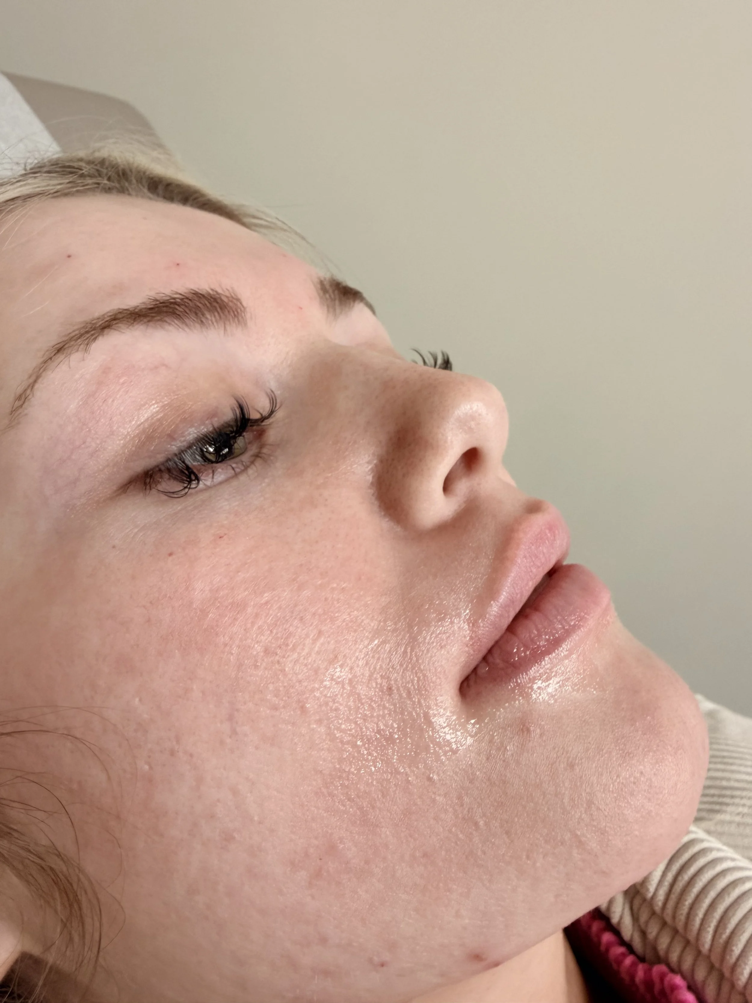 Lip Filler. Close-up of a woman's face showing her eye, nose, and lips with dewy skin, lying down on a neutral-colored pillow against a plain wall.