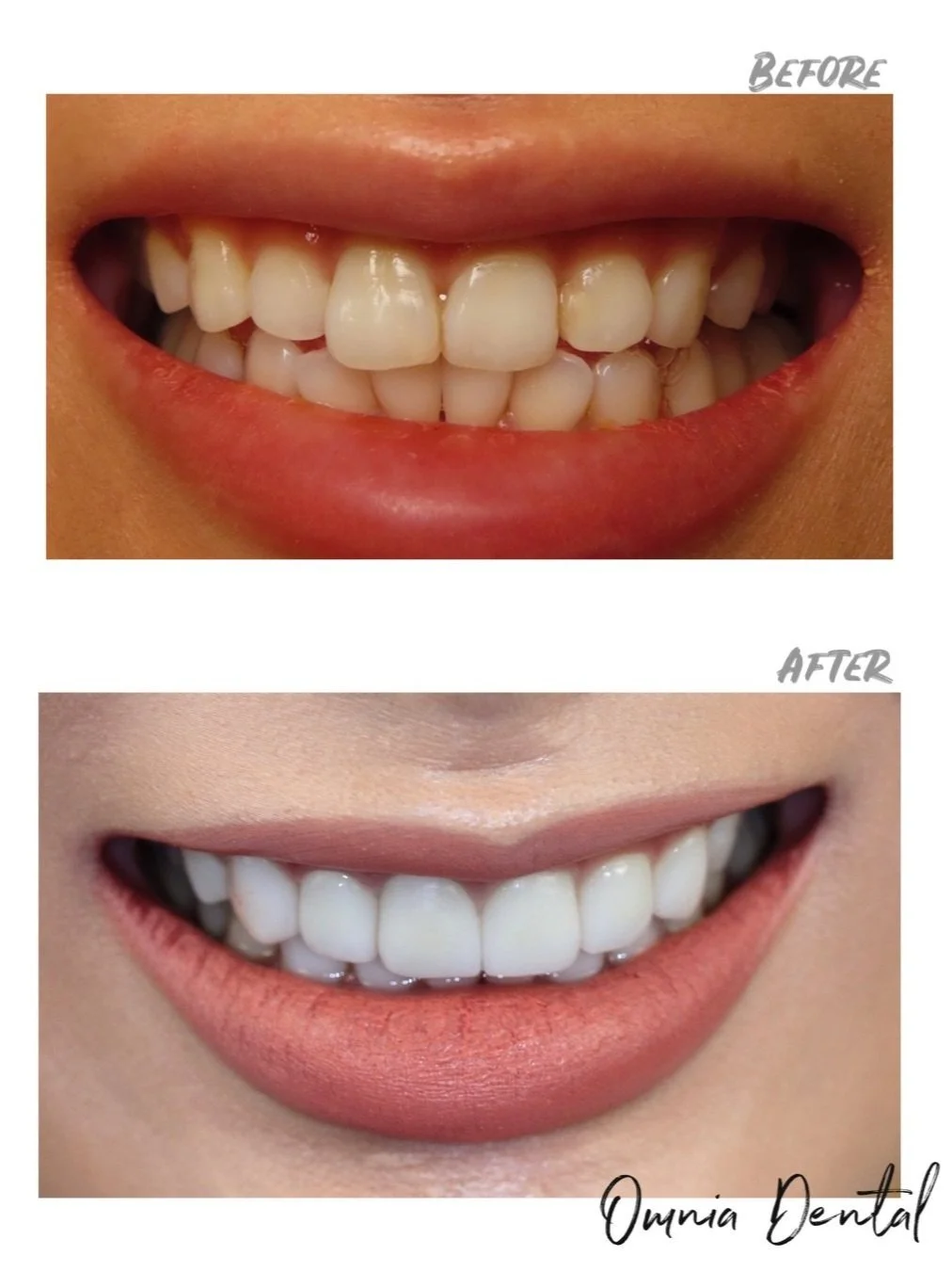 What are dental veneers?