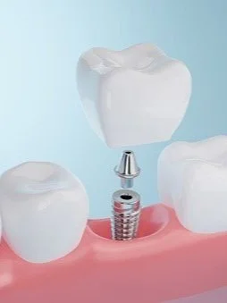 What is dental implant restoration? Everything You Need to Know
