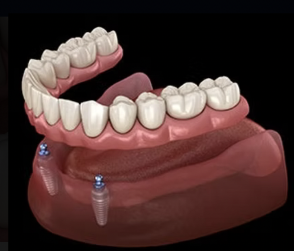 Dental model of upper and lower dentures with implant screws on a black background.