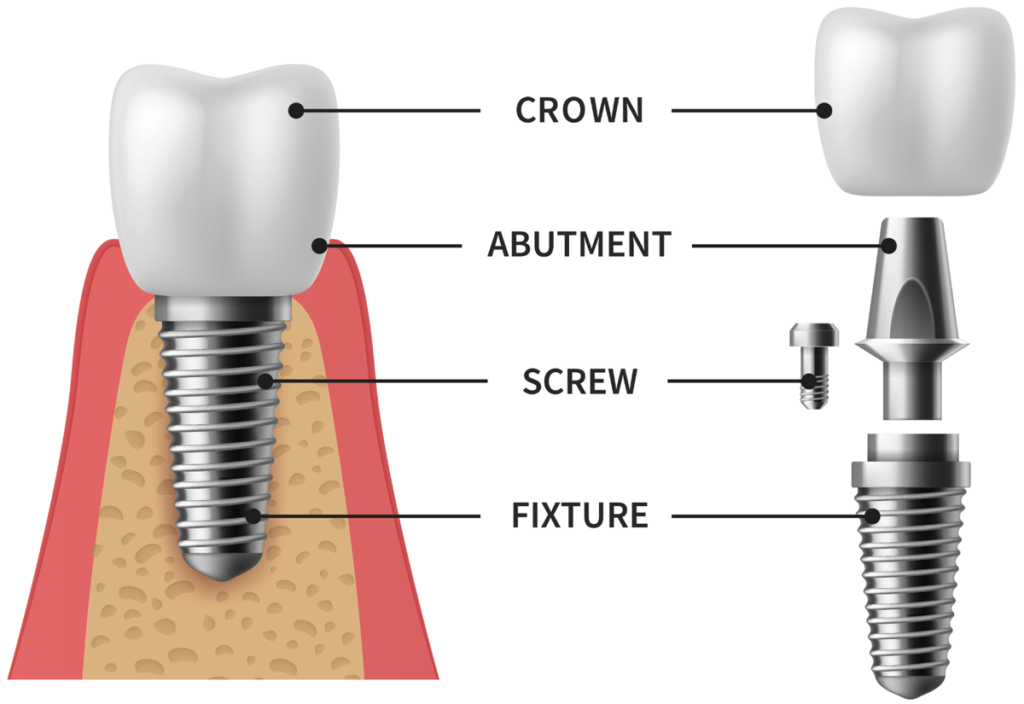 Diagram of a dental implant showing crown, abutment, screw, and fixture components.