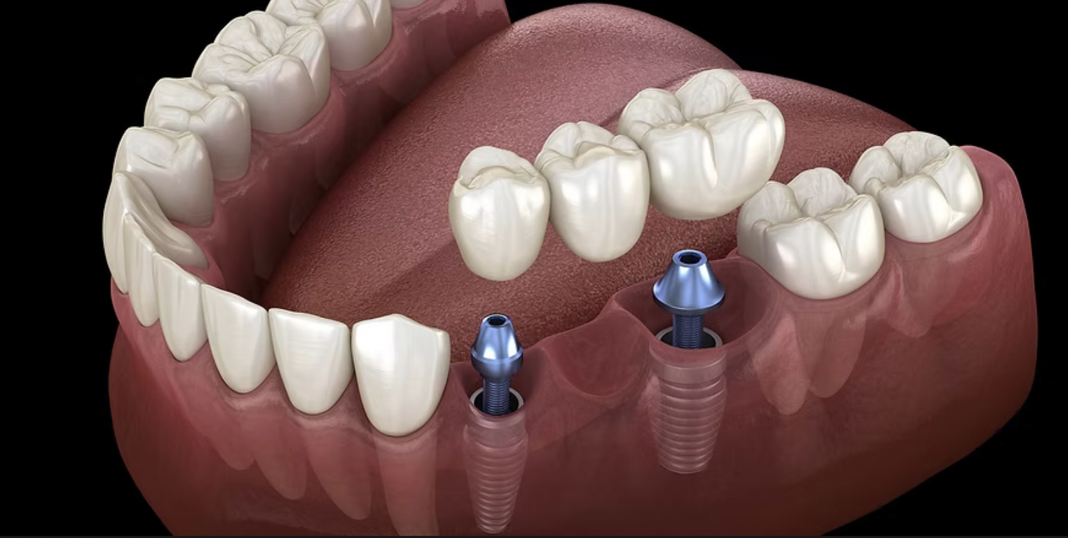 Digital illustration of a lower jaw with dental implants and abutments.