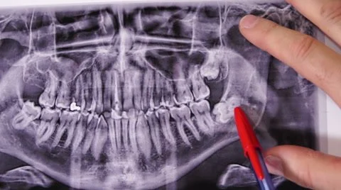 Dental X-ray showing upper and lower teeth and jaw structure, with a person holding a red pen pointing at the X-ray.