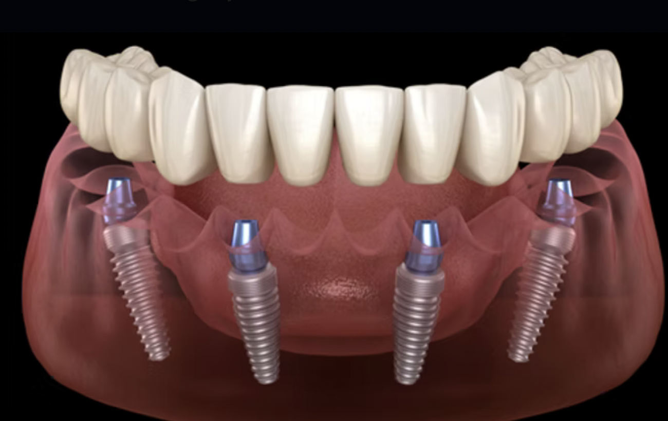 Digital illustration of a lower jaw with dental implants and a full set of upper teeth, showing dental implant screws in the lower jaw.