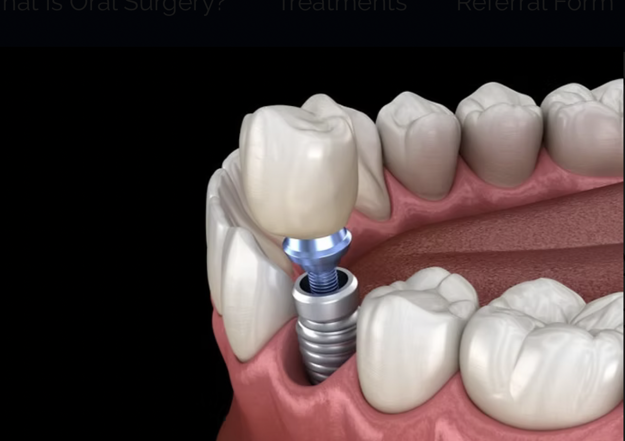 A digital illustration showing a dental implant, with a metal screw in the jawbone and a crown on top, replacing a missing upper molar.