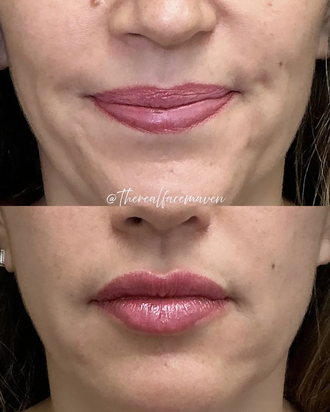 &ldquo;I&rsquo;ve always had good lips&hellip; but they feel deflated all of a sudden.&rdquo;

One day you&rsquo;re the girl with the perfect natural lips&hellip;
and the next you&rsquo;re like wait&hellip; why do they look smaller, flatter, and just