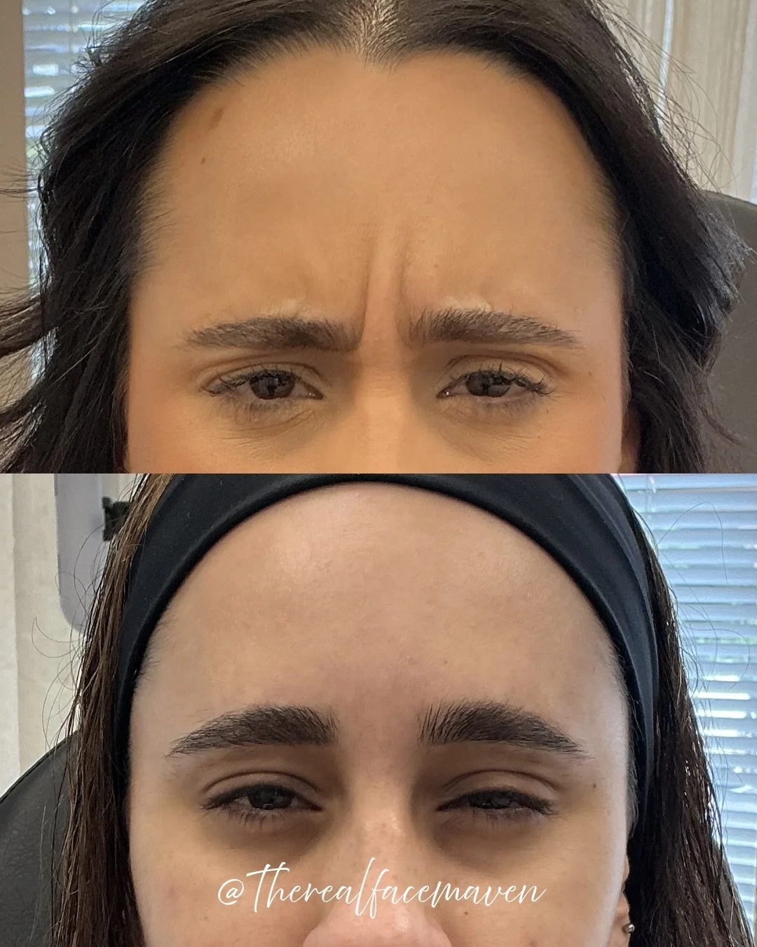 Daxxify&hellip;are you ready to try it yet? 

Whether you&rsquo;re a first timer to any injectable treatments like this client here&hellip; or a seasoned veteran, there&rsquo;s never been a better time to try something new! 🤌🏼

Available at @mavenh