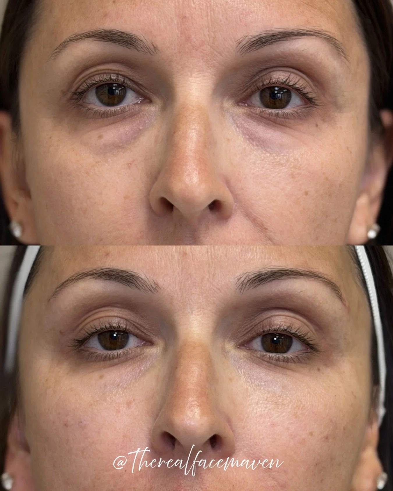 I don&rsquo;t know about you, but looking tired all the time is just NOT the vibe. 🙅🏼&zwj;♀️

No concealer.
No filters.
No extra sleep.

This is literally just strategic cheek &amp; under-eye rejuvenation.

Look at the shadows, hollowing, and overa