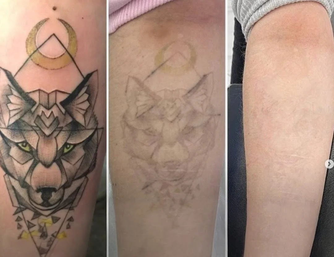 Tratamiento Eliminar Tatuaje en Alicante
