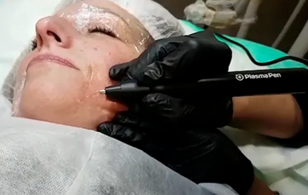 Medical professional wearing black gloves using a plasma pen on a mature woman's face in a clinical setting.