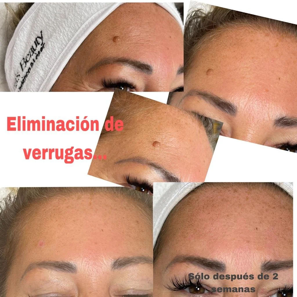 Collage of close-up photos of a woman's forehead showing the removal of wrinkles, with text in Spanish indicating wrinkle removal after two weeks.