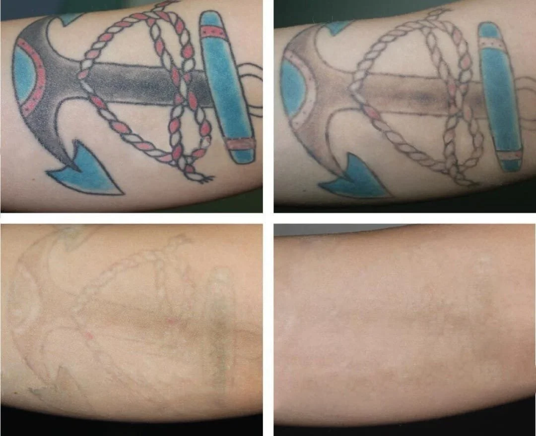 Progression of a tattoo cover-up process, showing an old tattoo of an anchor with a rope on upper arm and the new, more subtle skin after removal or covering.