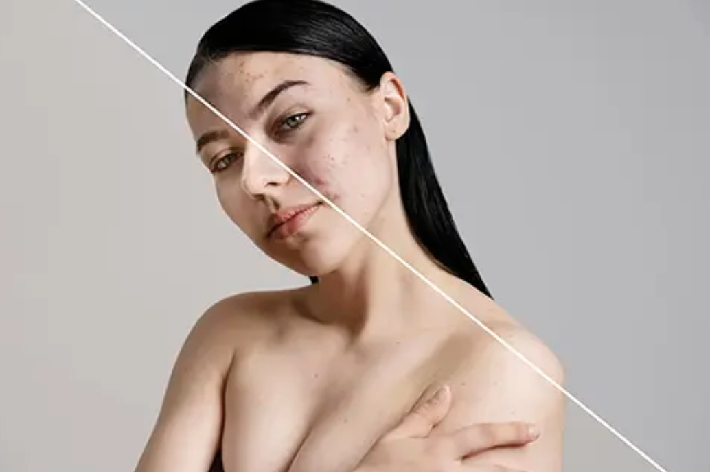 A woman with clear skin on her left side and acne on her right side, looking at the camera against a plain background.