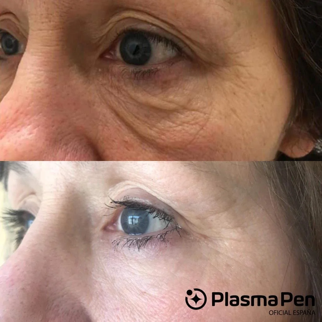 Close-up view of a woman's eye before and after facial treatment showing improved skin smoothness and reduced wrinkles, with the Plasma Pen logo in the bottom right corner.