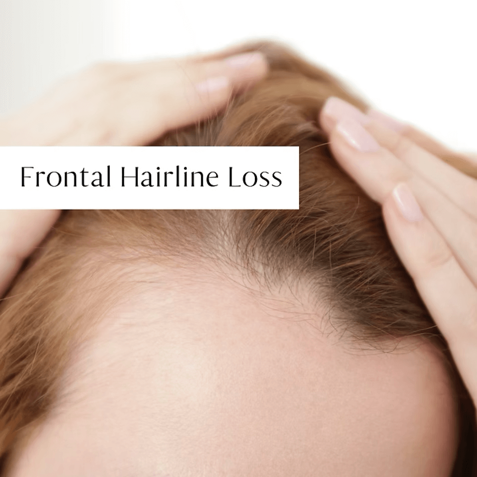 Frontal Hairline Loss: Causes, Prevention, and Treatments