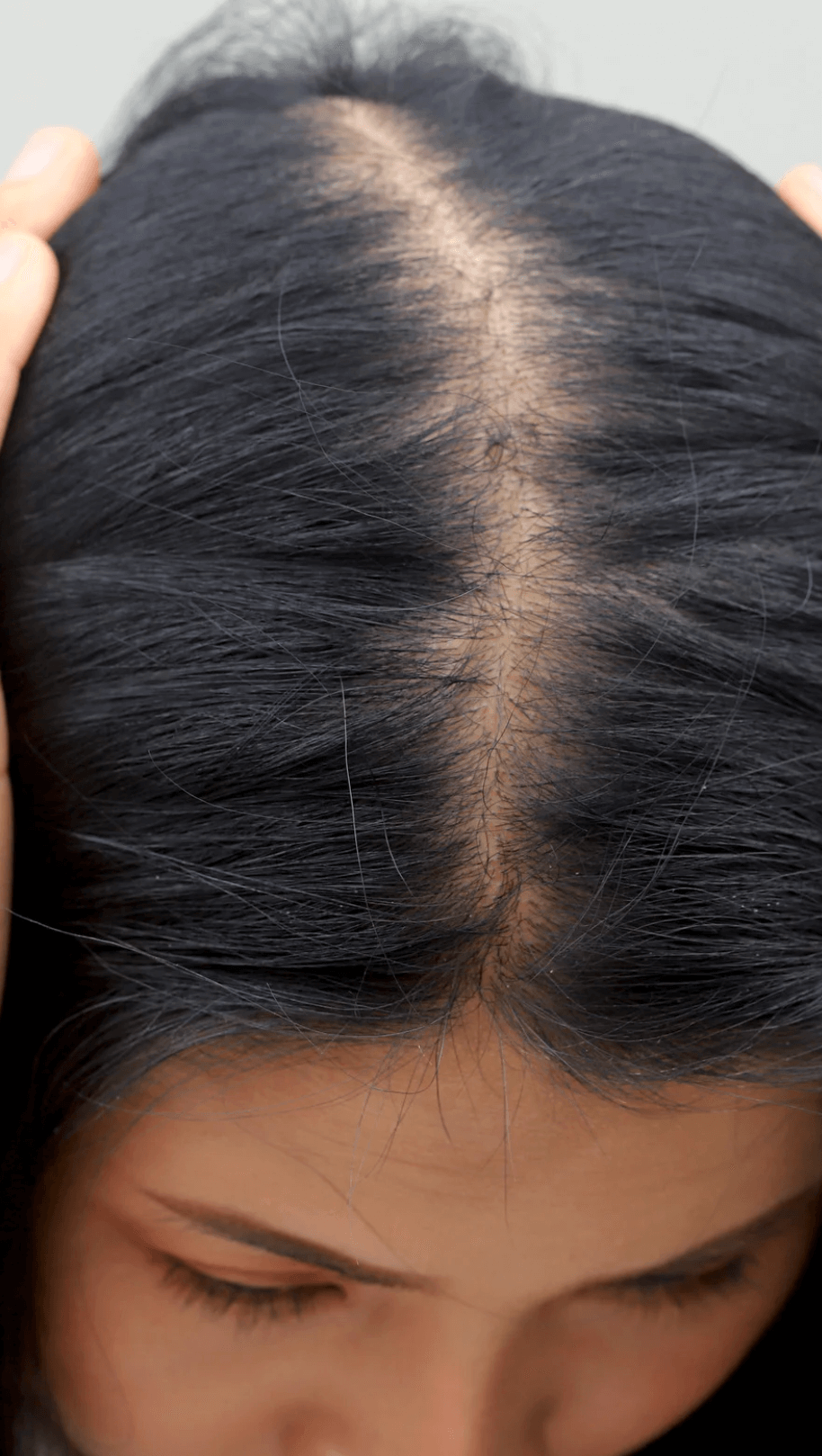 Treat Hiar Thinning Early to Prevent Permanet Loss 