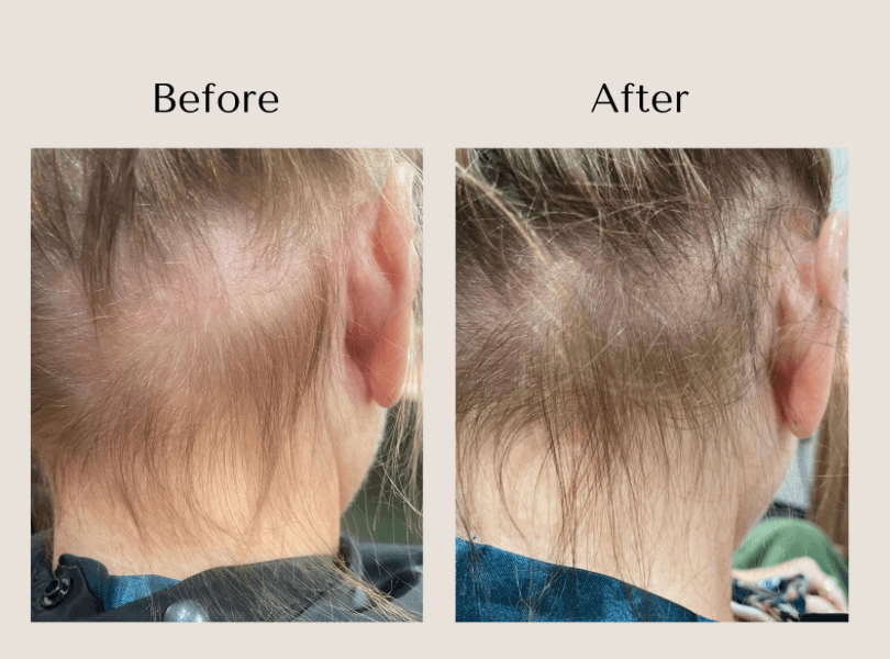 TED Hair Restoration before and after showing improved hair density and coverage at the nape at Root Revival Hair Restoration in Cumming, GA.