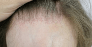 Frontal hairline recession with findings that may be consistent with Frontal Fibrosing Alopecia (FFA).