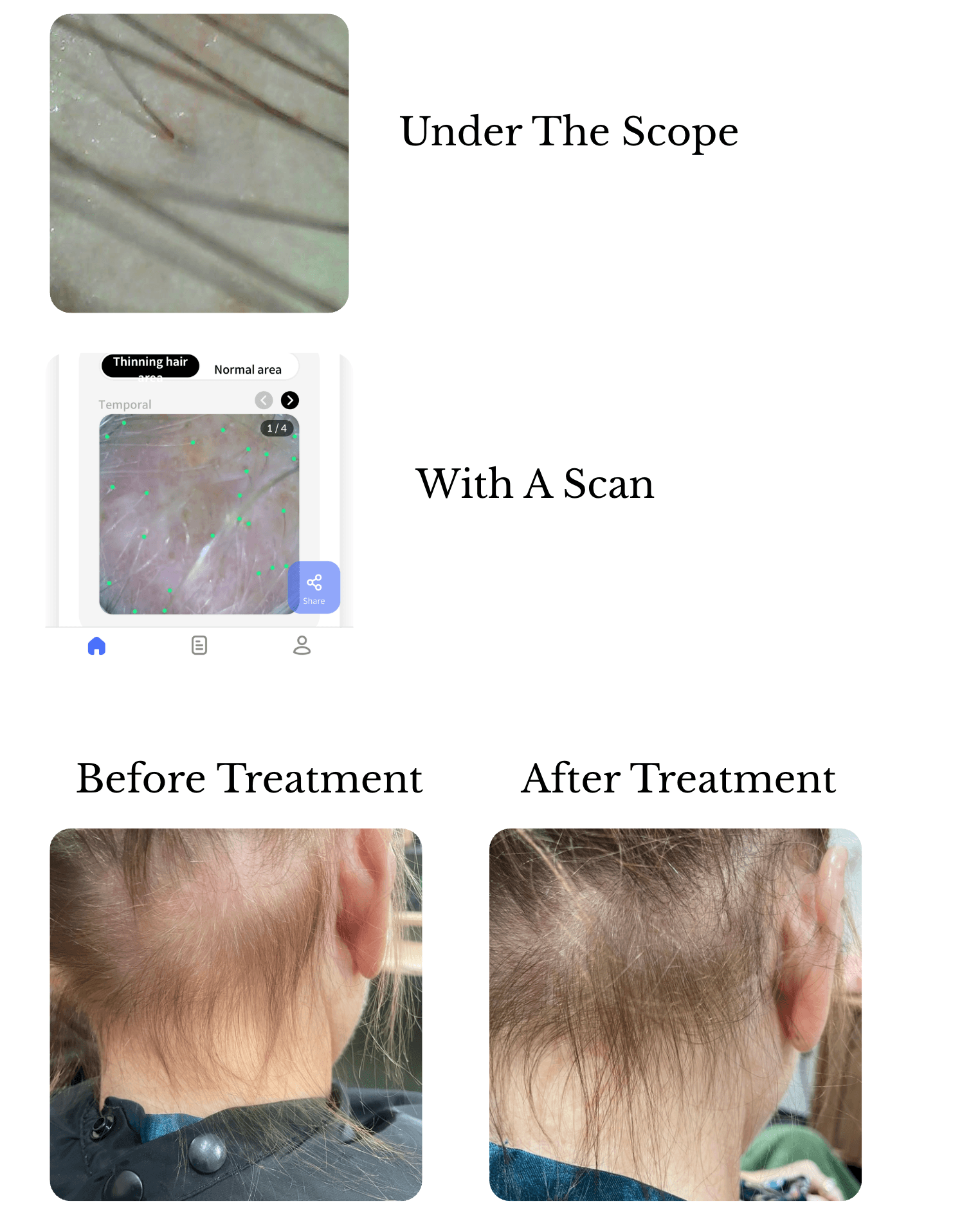Hair & Scalp Evaluation for hypotrichia with trichoscopy, digital hair density analysis, and before-and-after progress photographs