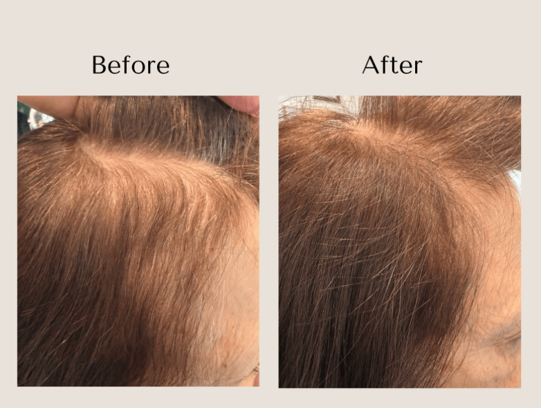 TED Hair Restoration before and after showing improved temple hair density at Root Revival Hair Restoration in Cumming, GA.