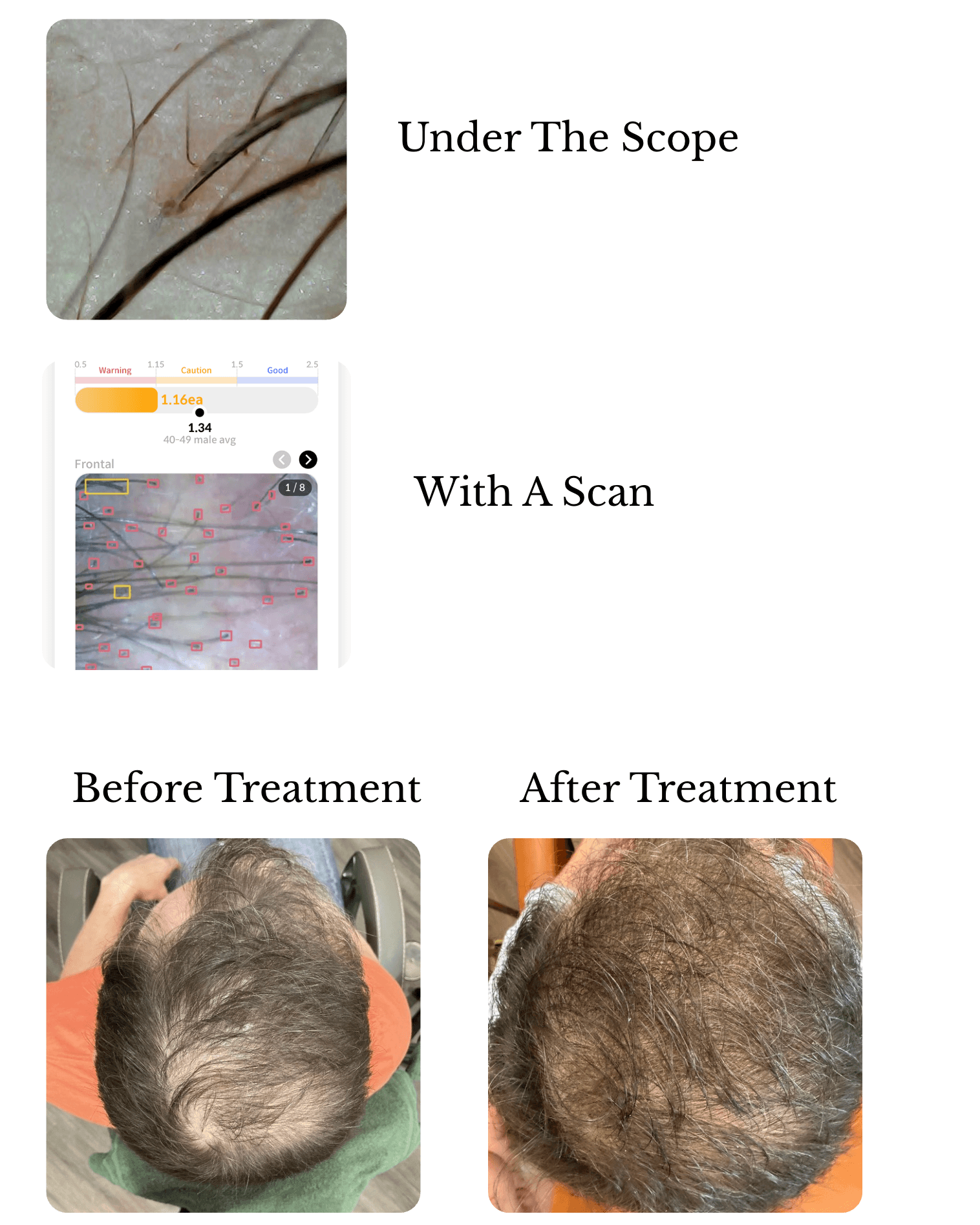 Hair & Scalp Evaluation for Androgenetic Alopecia with trichoscopy, digital hair density analysis, and before-and-after progress photographs.