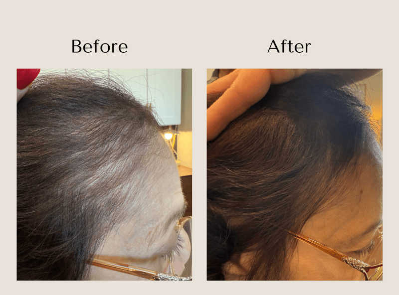 Before and after TED Hair Restoration showing improved density and coverage along the frontal hairline and temple.