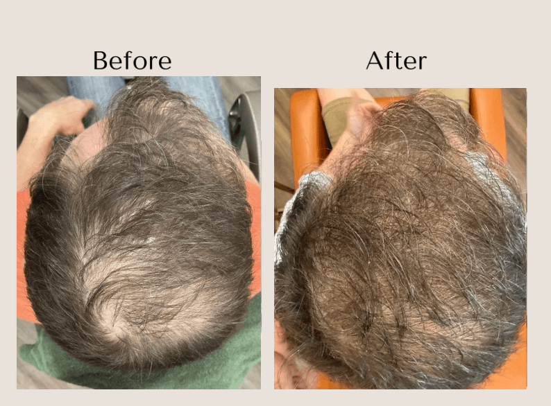 TED Hair Restoration before and after showing improved hair density and scalp coverage through the crown in a man with thinning hair at Root Revival Hair Restoration in Cumming, GA.