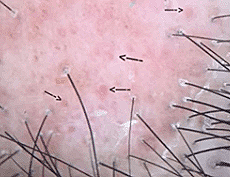Trichoscopic image showing scalp inflammation and perifollicular scaling with findings that may be consistent with Discoid Lupus Erythematosus (DLE).