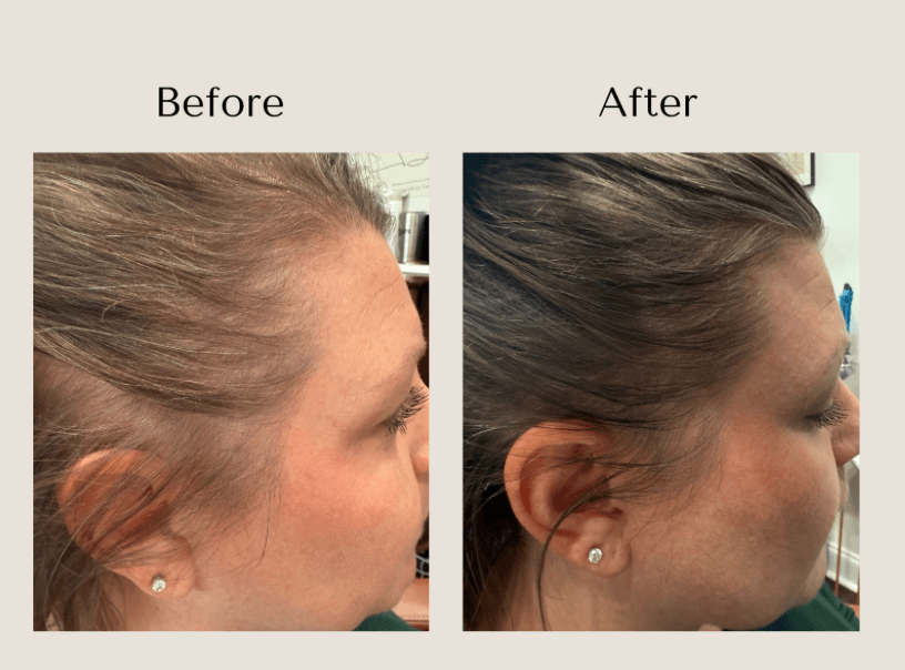 TED Hair Restoration before and after showing improved hair density and coverage along the temple and frontal hairline at Root Revival Hair Restoration in Cumming, GA.