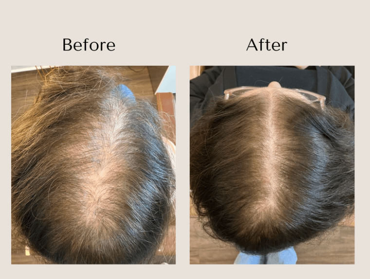 TED Hair Restoration before and after showing improved hair density and reduced scalp visibility through the part and crown at Root Revival Hair Restoration in Cumming, GA.