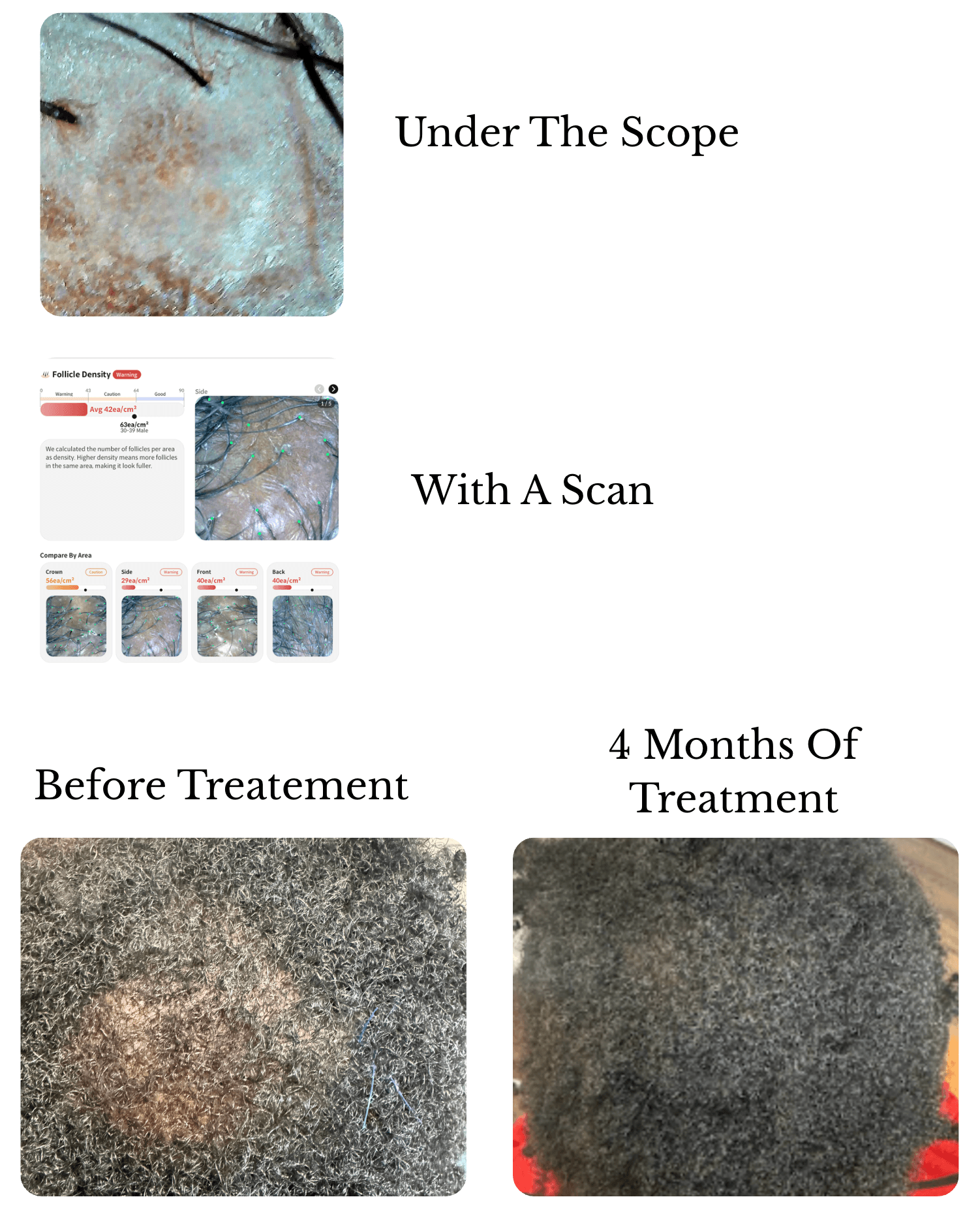 CCCA Hair & Scalp Evaluation showing trichoscopy, digital scalp analysis, and four-month progress photographs.