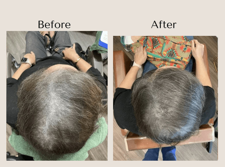 TED Hair Restoration before and after showing improved overall hair density and reduced scalp visibility in a woman with diffuse thinning at Root Revival Hair Restoration in Cumming, GA.